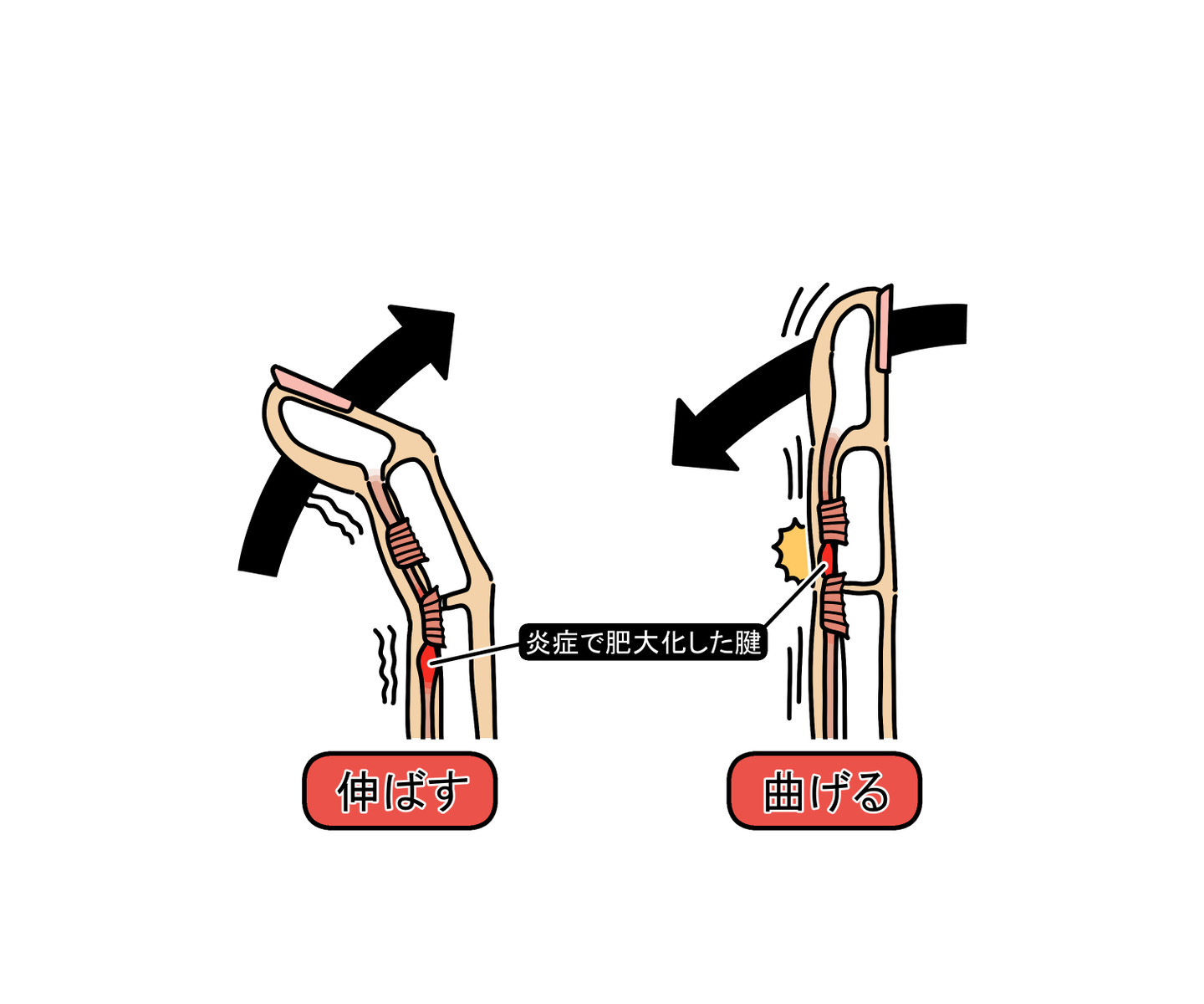ばね指
