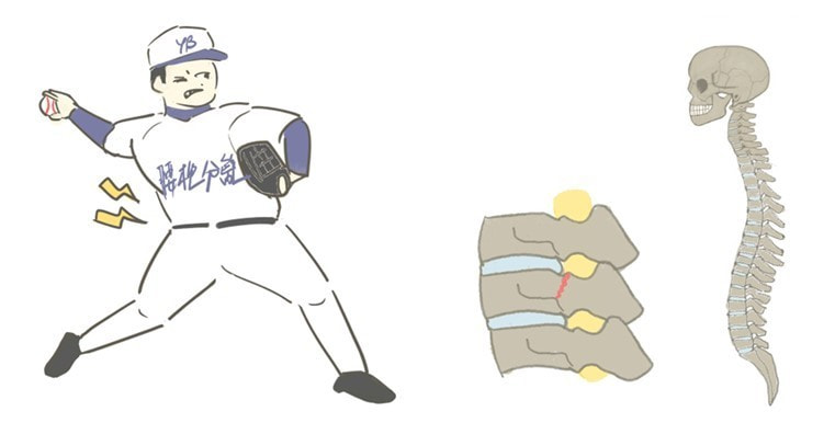 すべり症と分離症