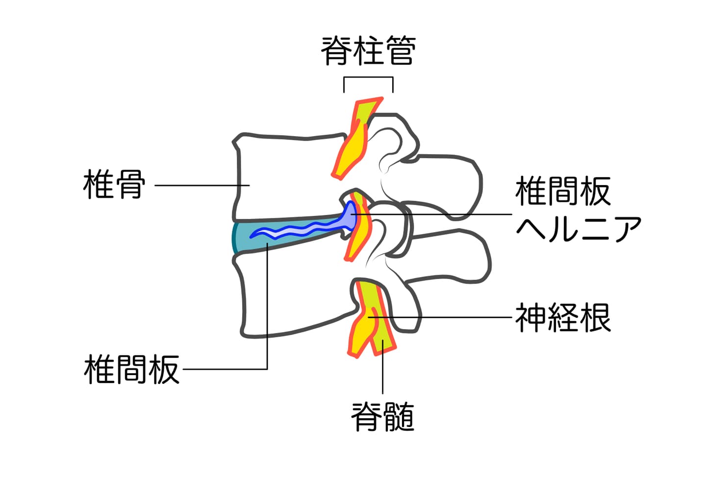 腰椎椎間板ヘルニア
