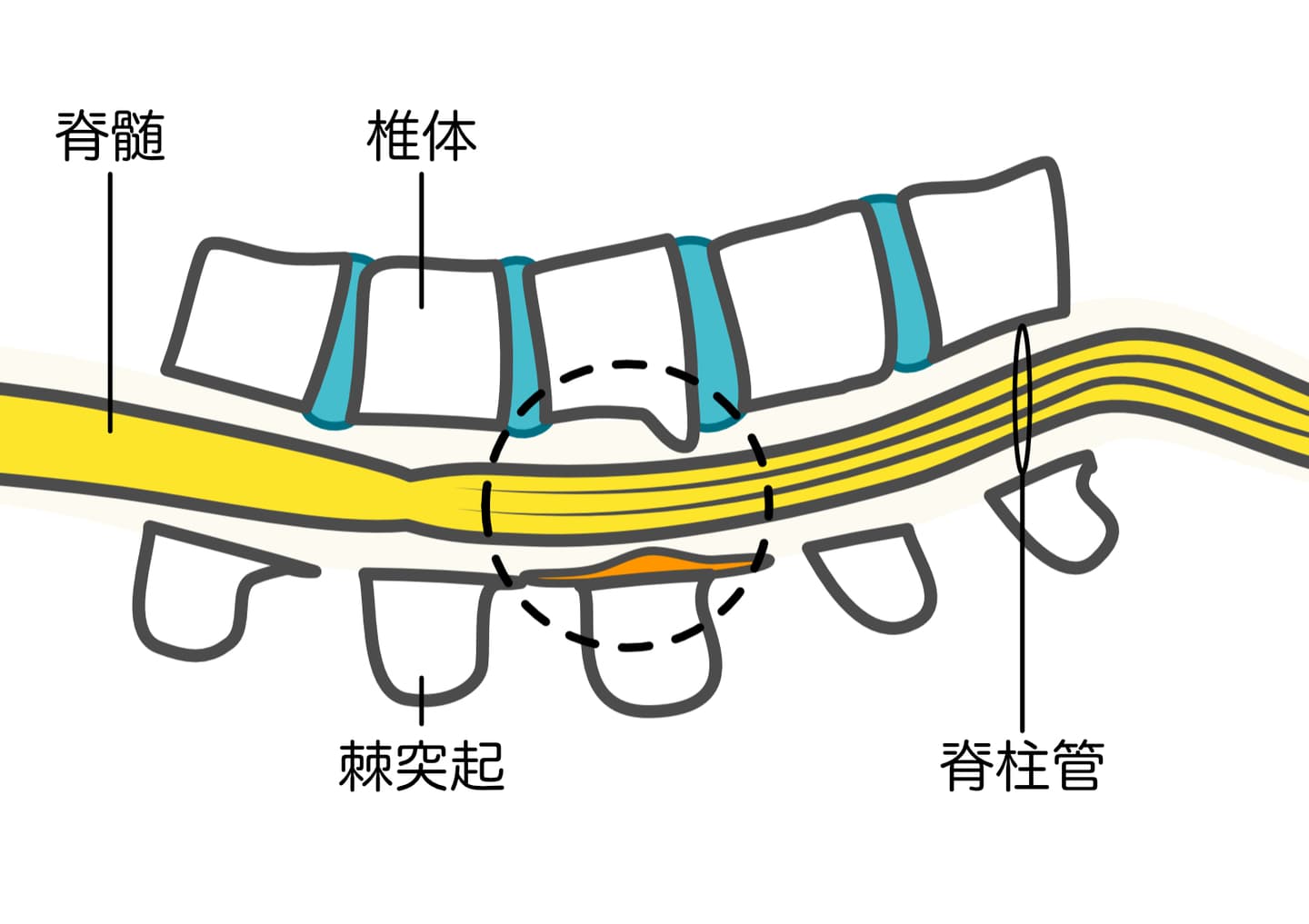脊柱管狭窄症